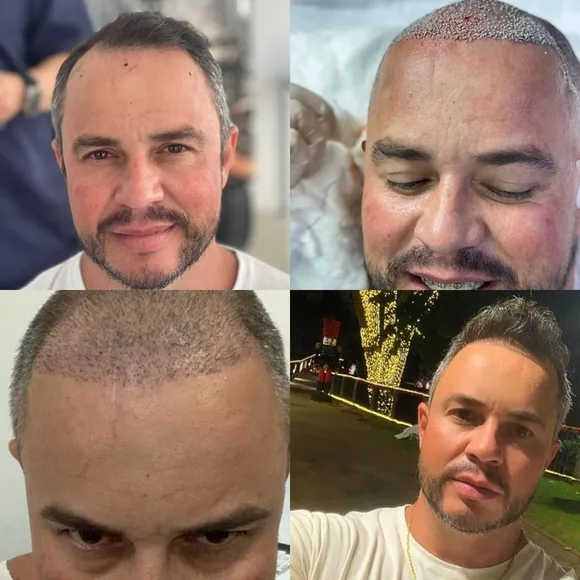 Antes e depois transplante capilar FUE - Paciente 4