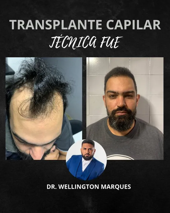 Antes e depois transplante capilar FUE - Paciente 7